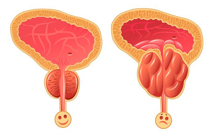 Normal ve iltihaplı prostat