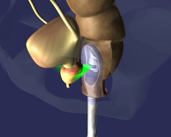 Prostatit için prostatın ultrason tedavisi