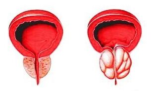 Normal durumdaki prostat (solda) ve prostatit ile iltihaplanmış (sağda)