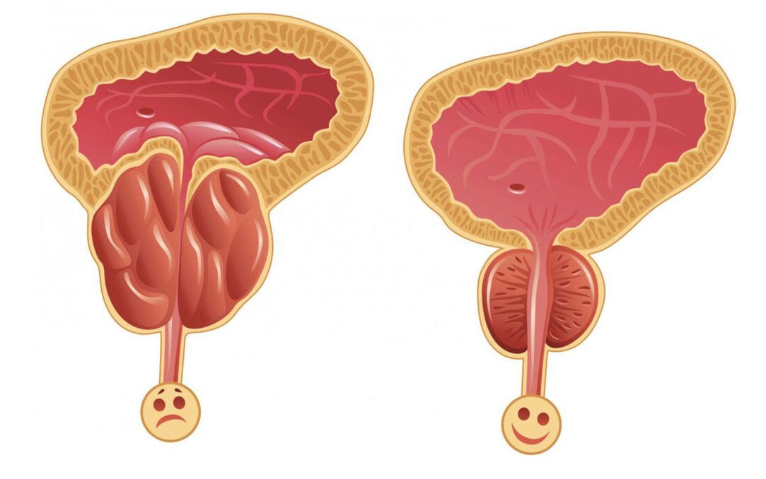 Prostatitli prostat iltihabı (solda) ve prostat bezi normaldir (sağda)
