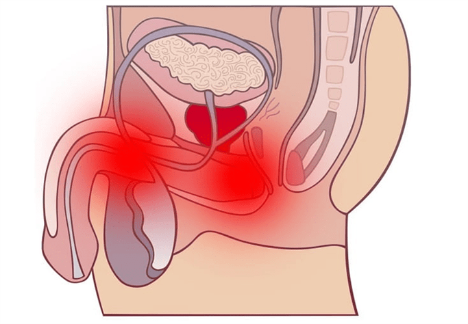 prostatit ile genital sistem iltihabı